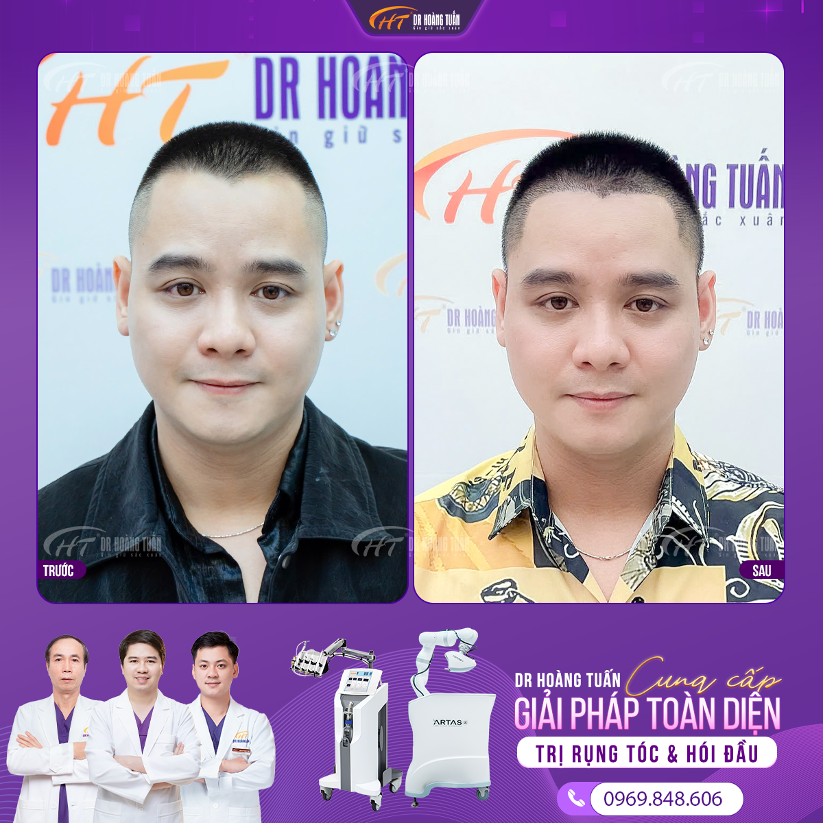 cấy tóc hói chữ m 
